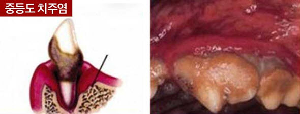 중등도 치주염