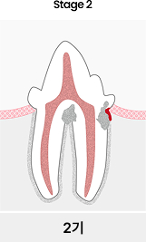 치아흡수성병변 2기