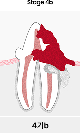 치아흡수성병변 4기b