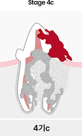 치아흡수성병변 4기c