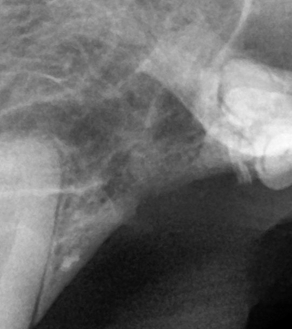 수술케이스 1 after