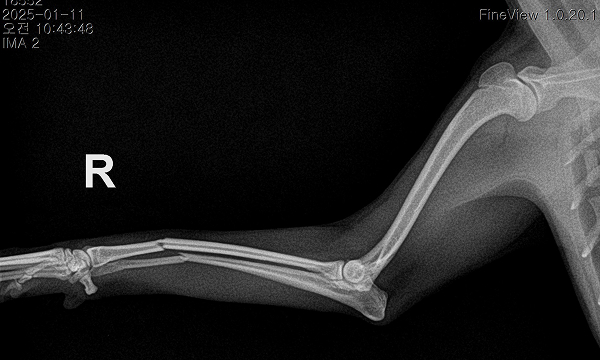 수술케이스 2 before