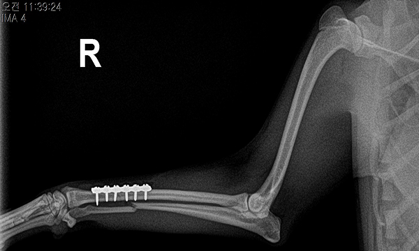 수술케이스 2 after