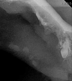 수술케이스 3 after