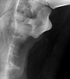 수술케이스 4 after