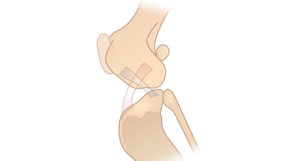 정상적인 십자인대